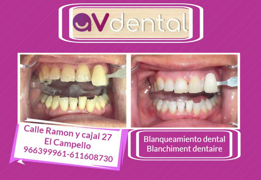 Blanqueamiento dental