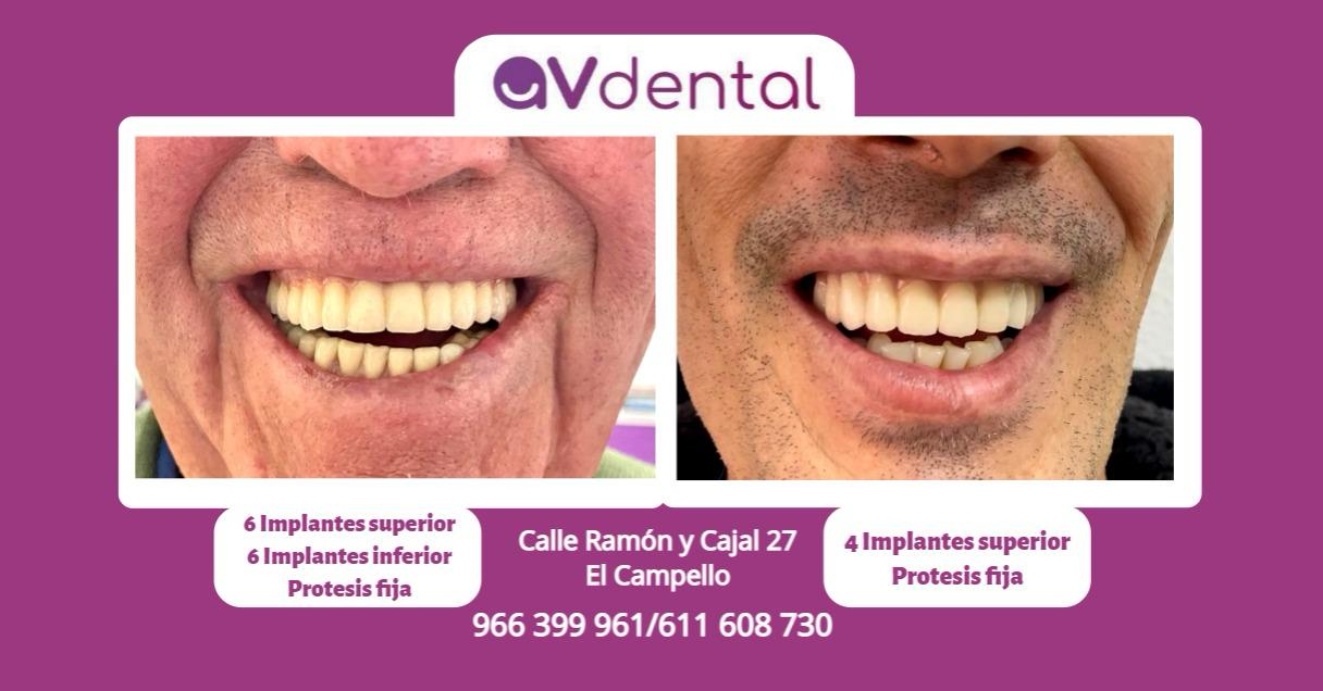 Implantes Dentales