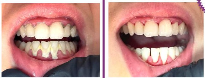 Periodoncia